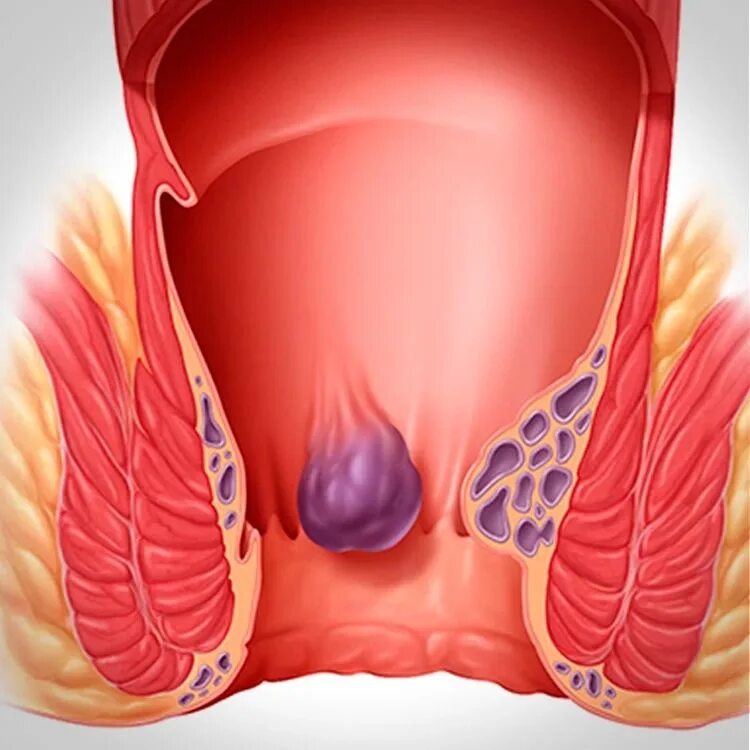 Признаки геморроя как выглядит Лигирование геморроидальных узлов