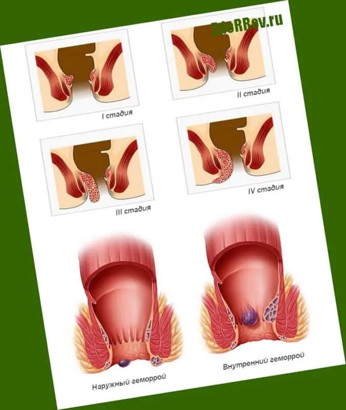 Признаки геморроя как выглядит Стадии геморроя схема