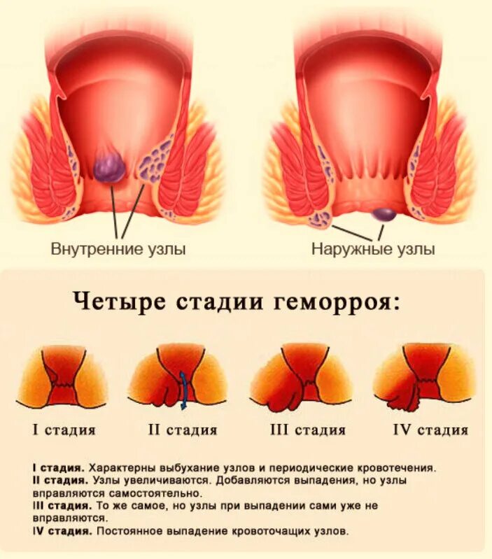 Признаки геморроя как выглядит Выпадение геморроидальных узлов фото у женщин - Азимут Тур