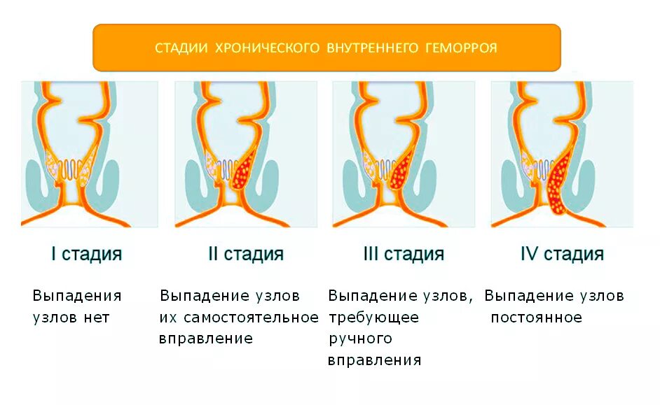 Признаки геморроя как выглядит Лечение геморроя клиника "Скандинавия"