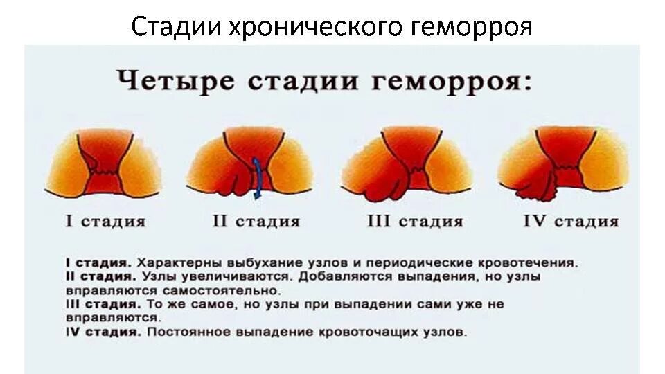 Признаки геморроя как выглядит Причины, симптомы и упражнения при геморрое у женщин Doctor-V.ru Медицинский Пор