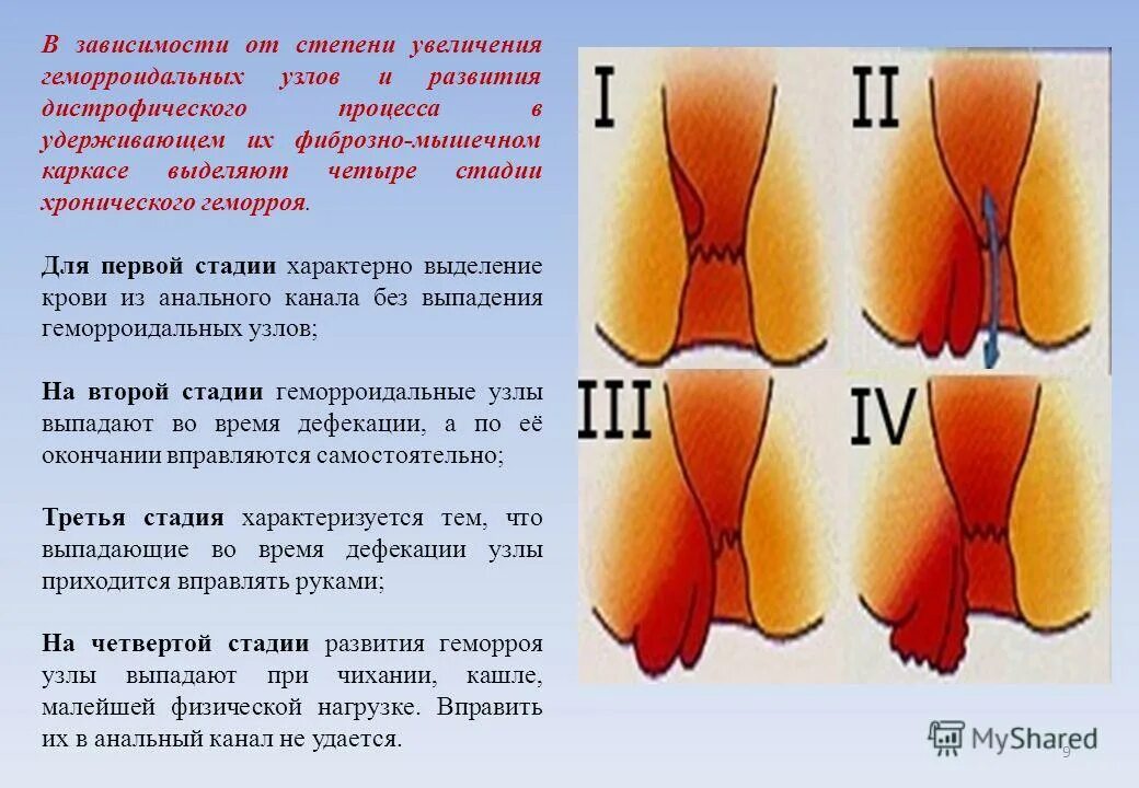 Признаки геморроя как выглядит Схемы лечения тромбоза геморроидальных узлов