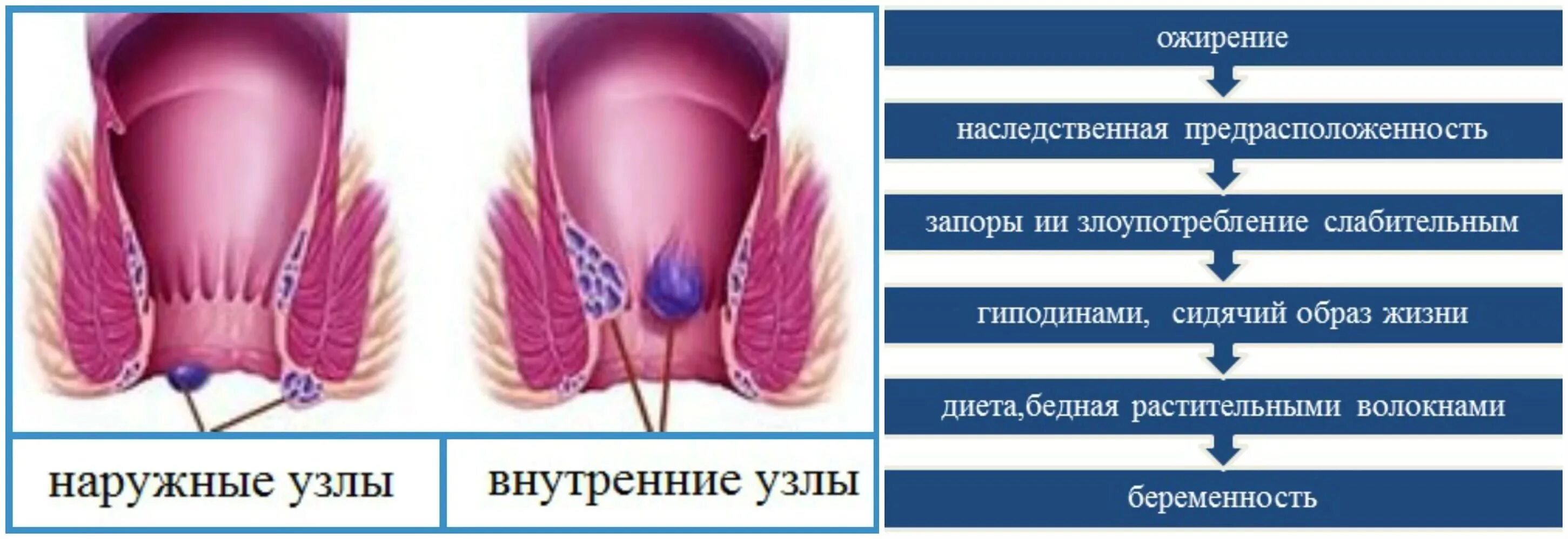 Признаки геморроя как выглядит Что нужно знать о геморрое? - Дегтяренко Сергей Петрович