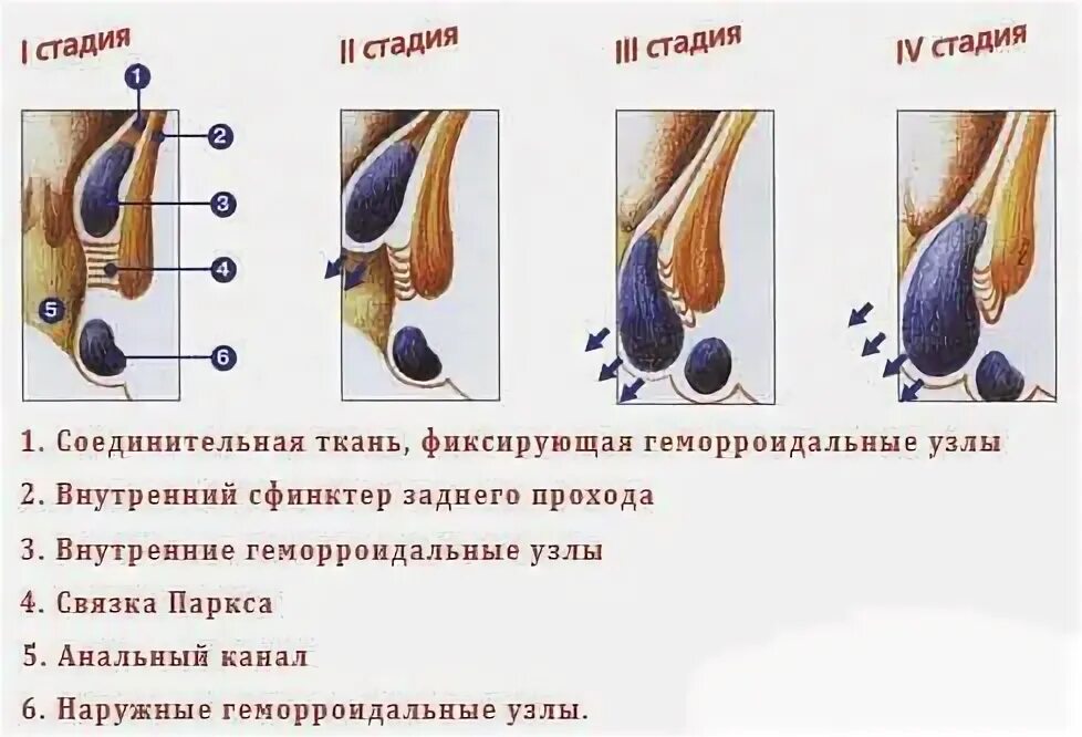 Признаки геморроя как выглядит Content - Промедклиник в Нижнем Новгороде