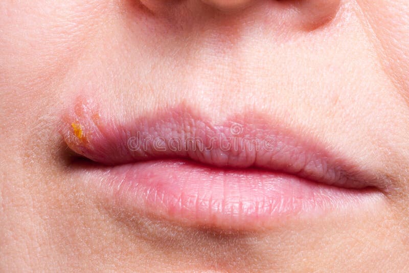 Признаки герпеса фото Herpes on the Lip Close Up Macro Stock Image - Image of adult, dermatology: 9286