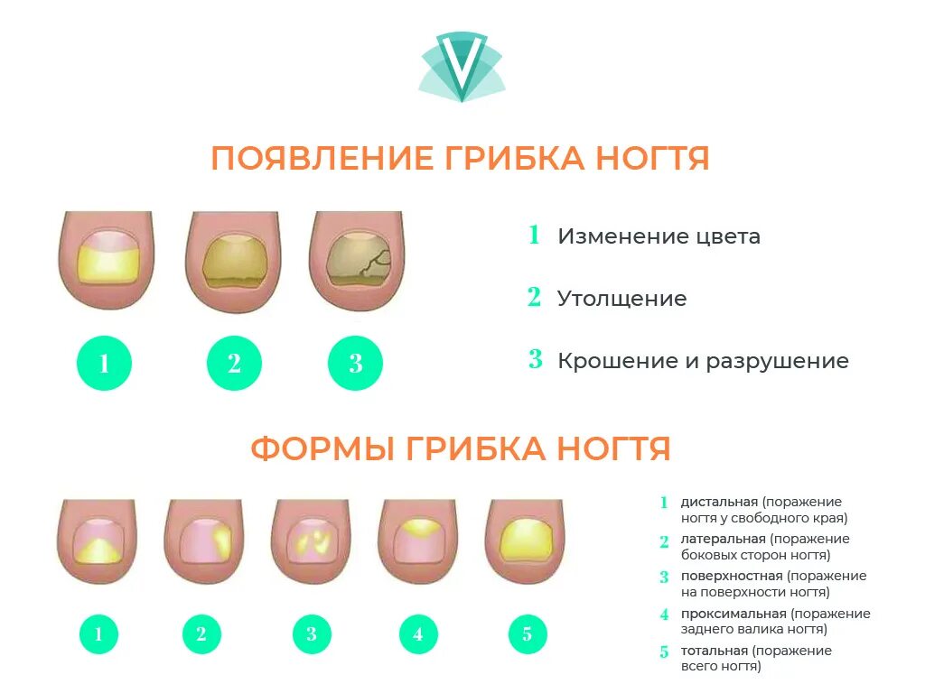 Признаки грибка ногтей фото Лечение грибка ногтей (онихомикоз) - блог Виртус