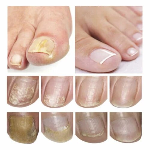 Признаки грибка ногтей фото Anti Fungal Nail Treatment Finger Toe Care Fungus Fungi Liquid Repair Liquid Pen