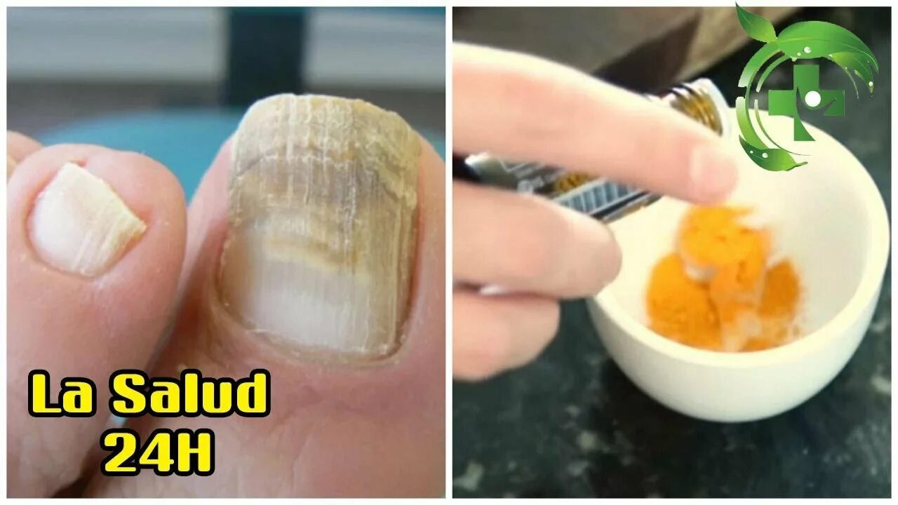 Признаки грибка ногтей фото Combate los hongos en las uñas con un tratamiento natural de cúrcuma. - YouTube