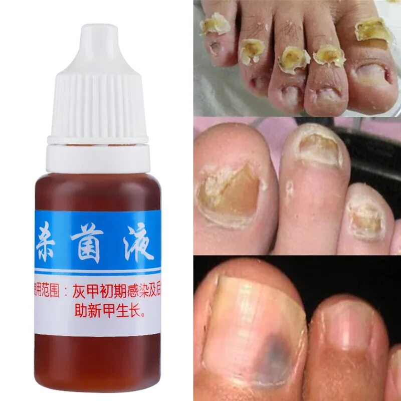 Признаки грибка ногтей на ногах фото 10ml Toe Nail Fungus Treatment Kills 99.9% Bacteria Anti Fungal Nail Infection R