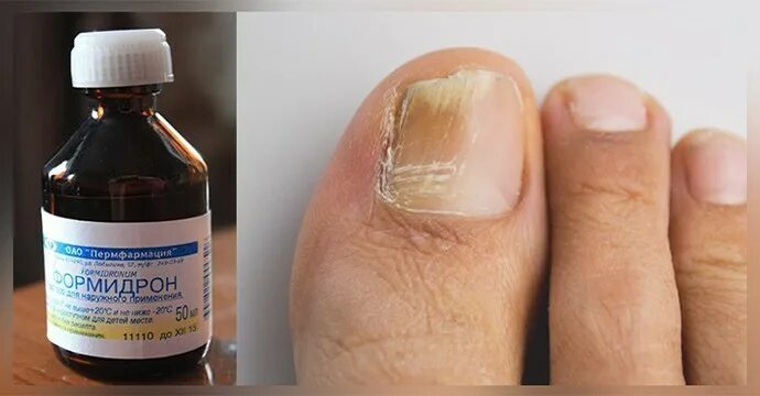 Признаки грибка ногтей на ногах фото Formidron from nail fungus: reviews, instructions for use