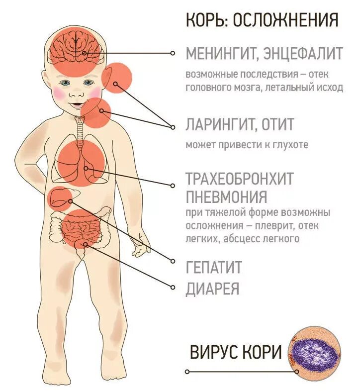 Признаки кори симптомы взрослых фото ПОЛЕЗНАЯ ИНФОРМАЦИЯ