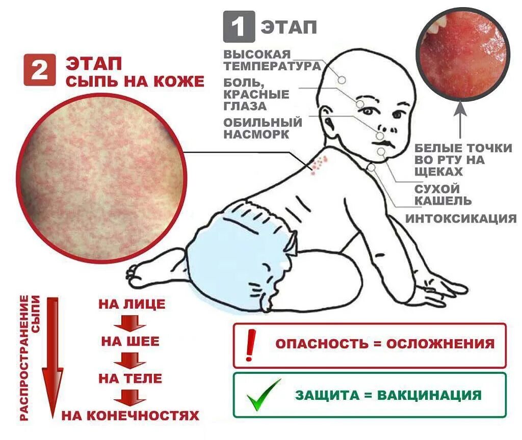 Признаки кори симптомы взрослых фото Корь Официальный сайт органов местного самоуправления Труновского муниципального