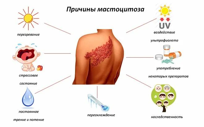 Признаки крапивницы у взрослых фото симптомы Пигментная крапивница у детей и взрослых (мастоцитоз): причины, симптомы и прави