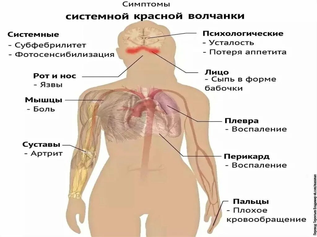 Признаки красной волчанки фото Вощанка - CoffeePapa.ru