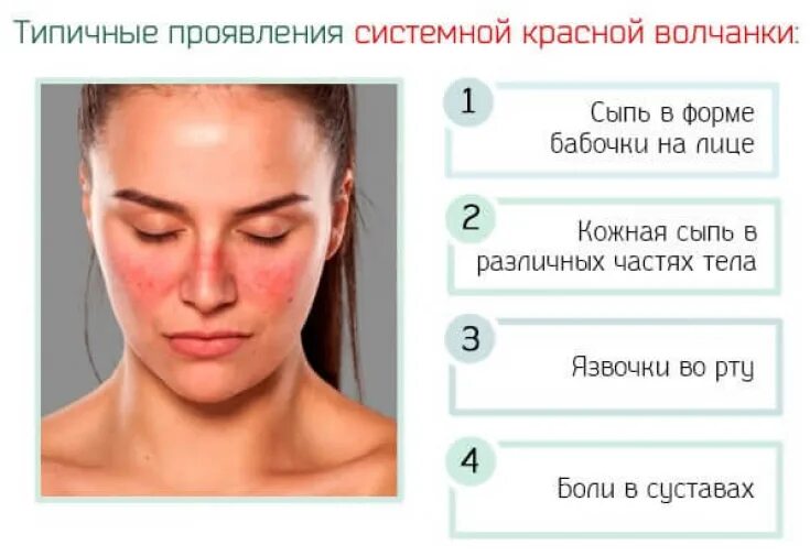 Признаки красной волчанки фото Skin lesions in systemic lupus erythematosus - Estet-Portal