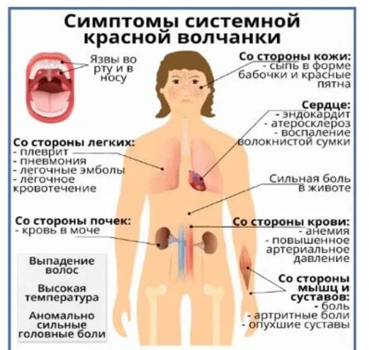 Признаки красной волчанки фото Волчанка и беременность