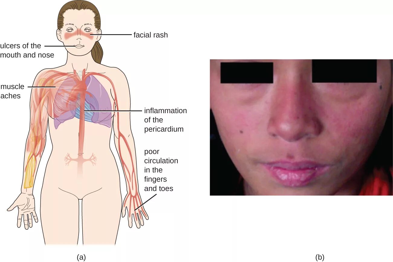 Признаки красной волчанки фото Autoimmune Disorders Microbiology