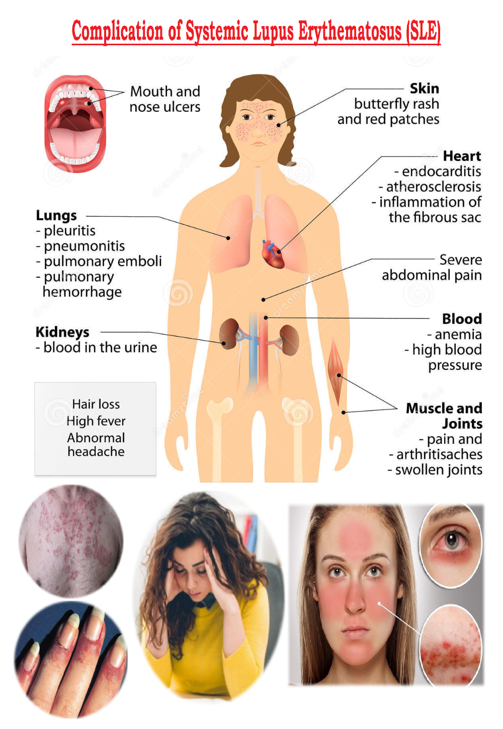 Признаки красной волчанки фото Pin on Med surge