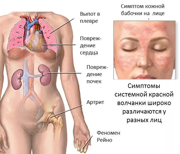 Признаки красной волчанки фото Особенности течения системной красной волчанки и ее лечение