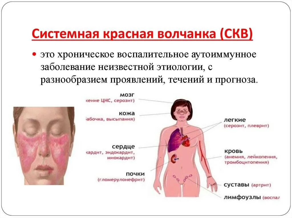 Признаки красной волчанки фото Картинки СИСТЕМНАЯ КРАСНАЯ ВОЛЧАНКА ОТНОСИТСЯ