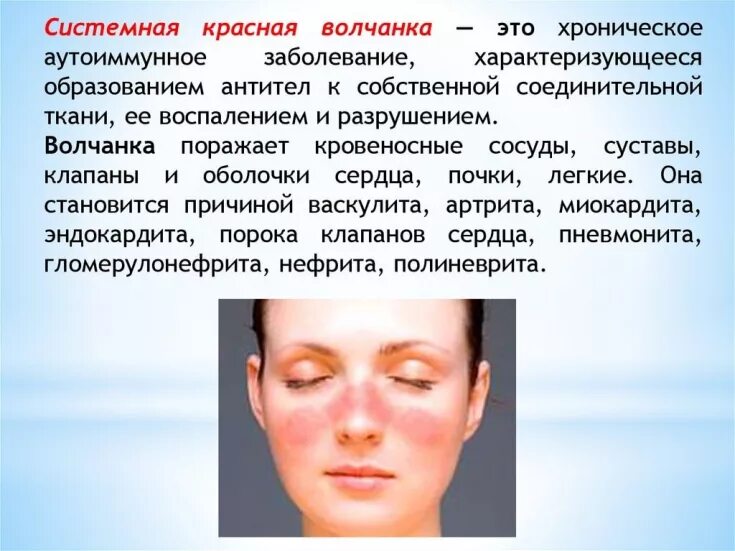 Признаки красной волчанки фото Features of drug therapy for systemic lupus erythematosus - Estet-Portal