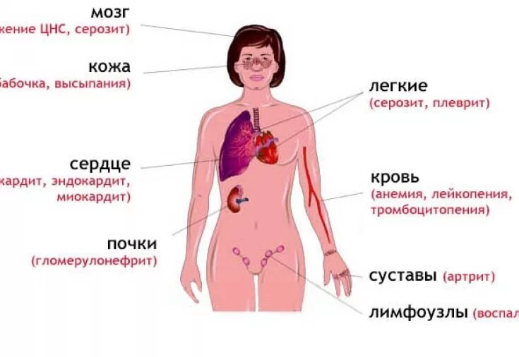 Признаки красной волчанки фото Системная красная волчанка: почему важна своевременная терапия - Estet-Portal