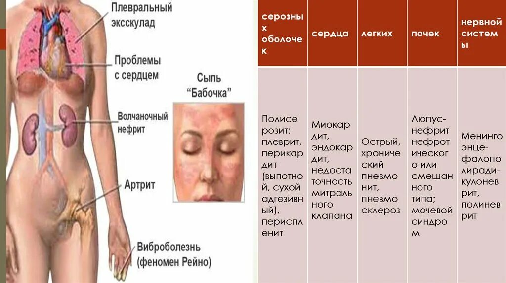 Признаки красной волчанки у женщин фото Волчанка и беременность