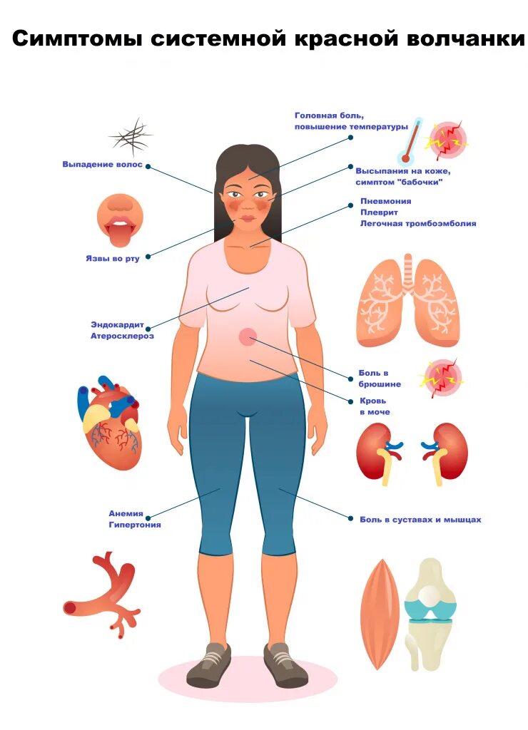 Признаки красной волчанки у женщин фото Системная красная волчанка - причины появления, симптомы заболевания, диагностик