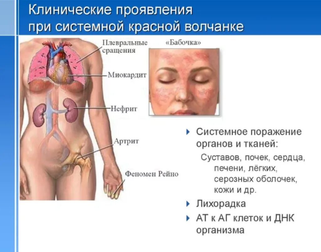 Красная волчанка - Медицинская энциклопедия