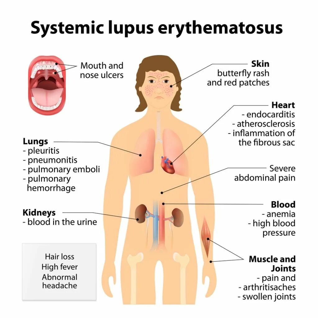 Признаки красной волчанки у женщин фото New Case-Study Highlights PAH-associated with Systemic Lupus... Essential oils f