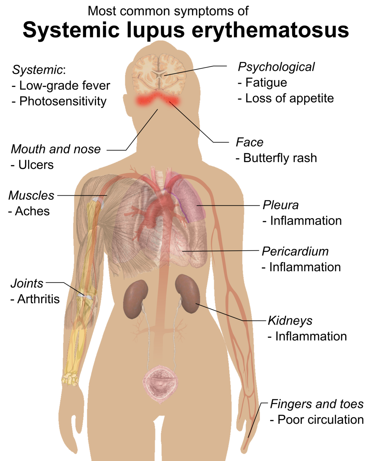 Признаки красной волчанки у женщин фото Fișier:Symptoms of SLE.png - Wikipedia