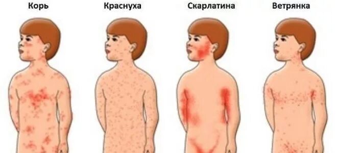 Признаки краснухи у детей фото начальной стадии Краснуха у детей: симптомы, лечение, профилактика, видео