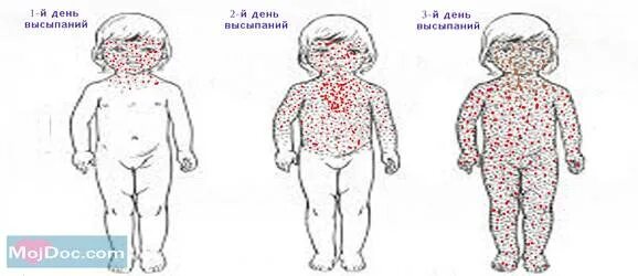 Признаки краснухи у взрослых фото симптомы Может ли ветрянка у детей протекать без температуры и при небольшом количестве в