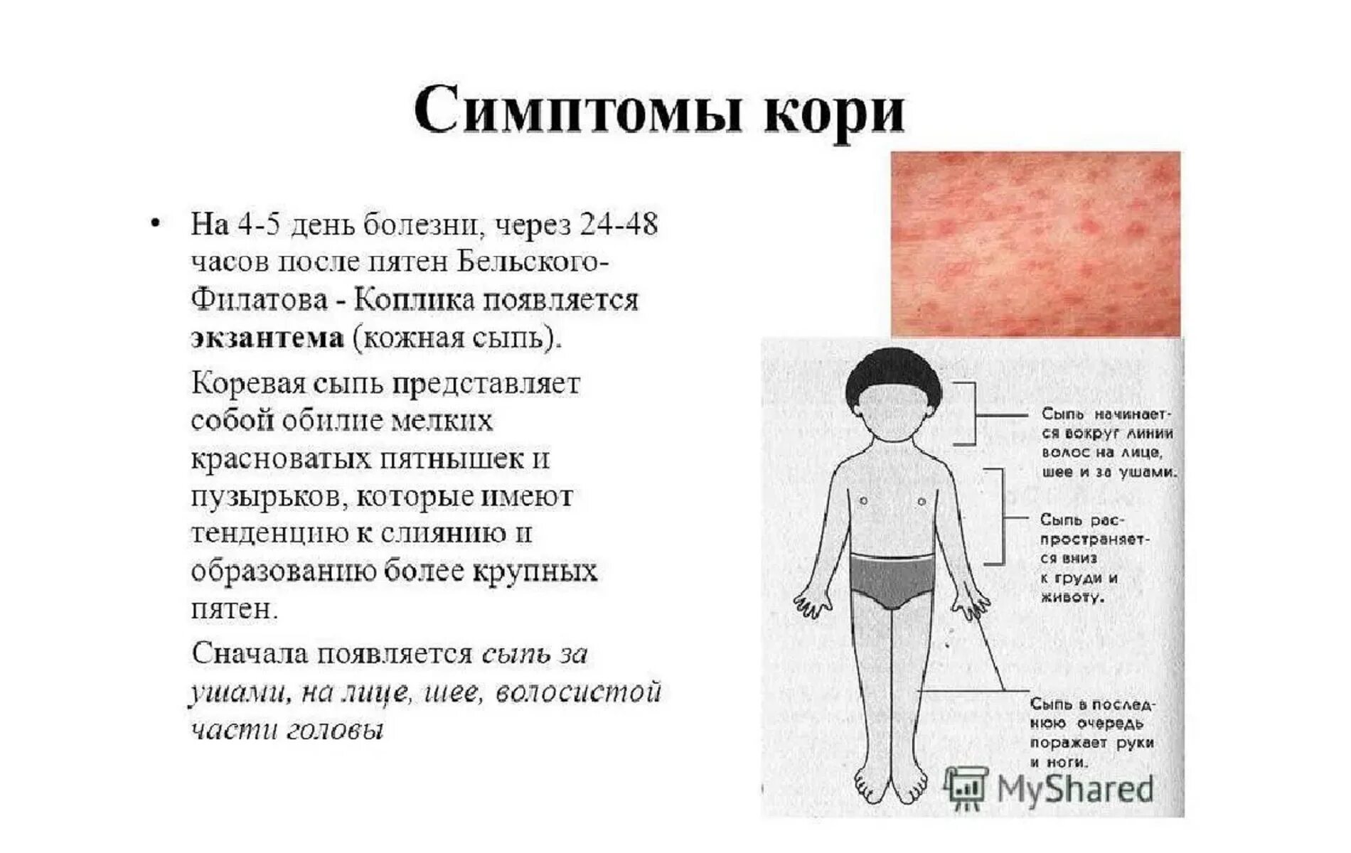 Признаки краснухи у взрослых фото симптомы Сыпь у ребенка виды болезней - найдено 89 картинок