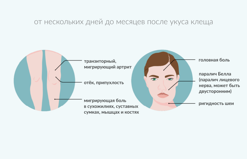 Признаки лайма симптомы у человека фото Болезнь Лайма: симптомы, лечение и профилактика клещевого боррелиоза