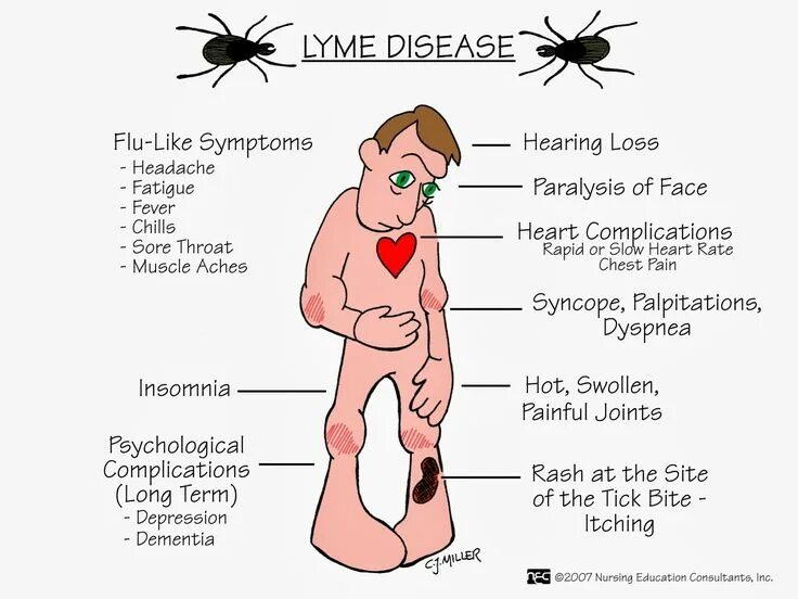 Признаки лайма симптомы у человека фото Pin on INFECTIONS