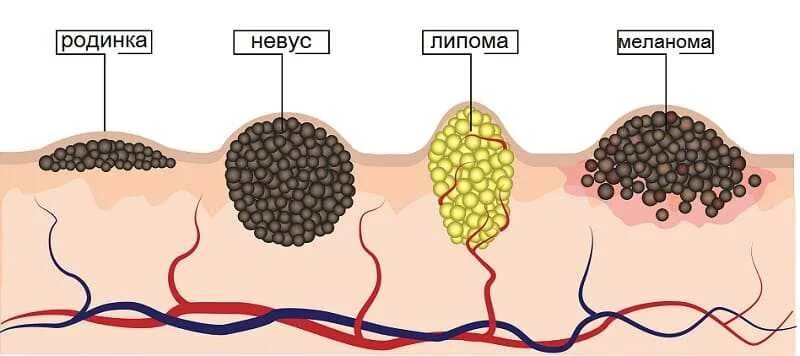 Признаки меланомы кожи у человека симптомы фото Болезнь Паркинсона и меланома - Клиника восстановительной неврологии " Новости