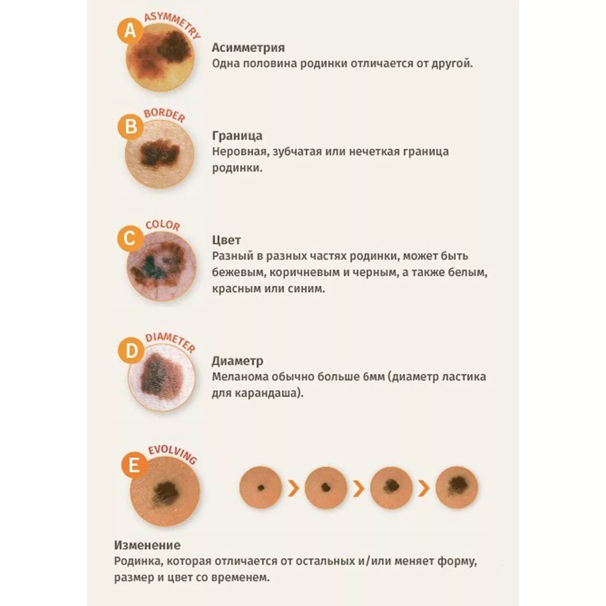 Признаки меланомы кожи у человека симптомы фото Рак кожи. Как выглядит злокачественное кожное образование Медицинский центр "Диа