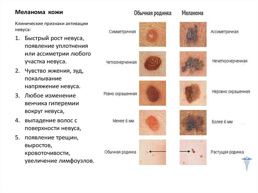 Признаки меланомы кожи у человека симптомы фото Профилактика меланомы и рака кожи - Подумай о здоровье - УЗ "16-я городская поли