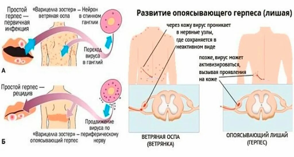 Признаки опоясывающего лишая фото Лишить существовать: найдено 59 изображений