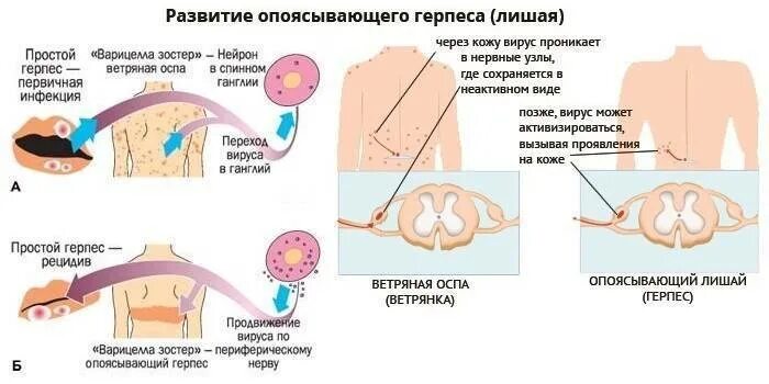 Признаки опоясывающего лишая у человека фото Симптомы опоясывающего лишая у детей, диагностика и схема лечения вируса герпеса