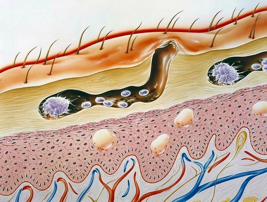 Признаки подкожного клеща у человека фото Чесотка