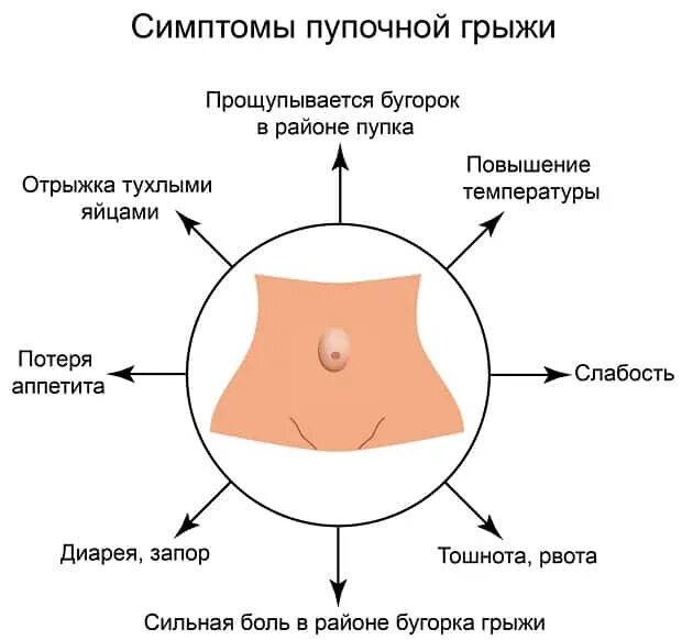 Признаки пупочной грыжи у женщин симптомы фото Пупочная и паховая грыжа - Диасс