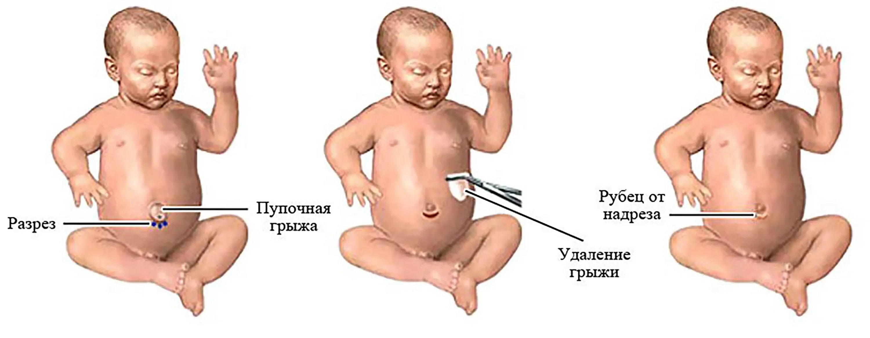 Признаки пупочной грыжи у женщин симптомы фото Желудок ребенка до года: найдено 85 изображений