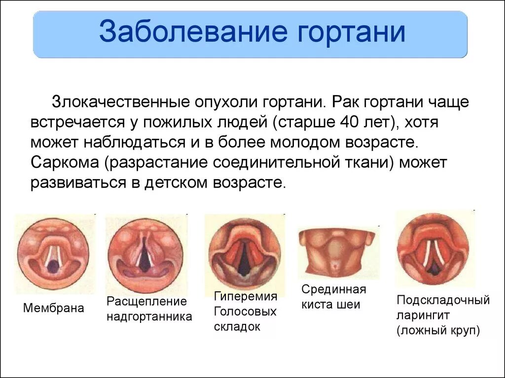 Признаки рака горла и гортани фото Хондроперихондрит гортани