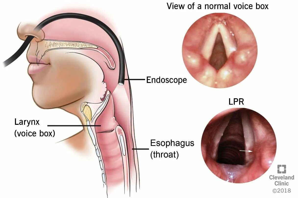 Признаки рака горла у женщин фото Acid reflux and your throat Vinmec