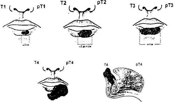 Признаки рака губы симптомы и фото Рак нижней губы