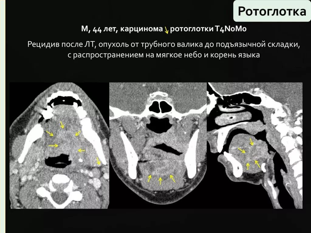 Рак полости рта в Индии лучшим онкологом головы и шеи