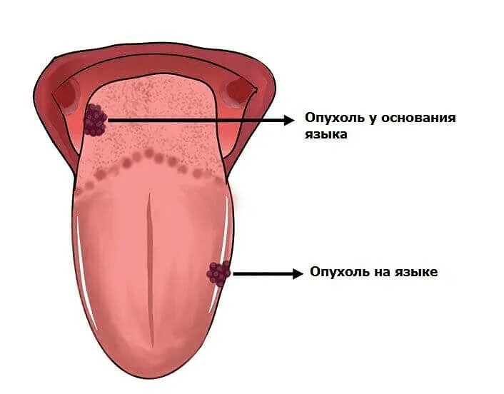 Признаки рака языка у женщин симптомы фото Рак языке - Вопросы и ответы