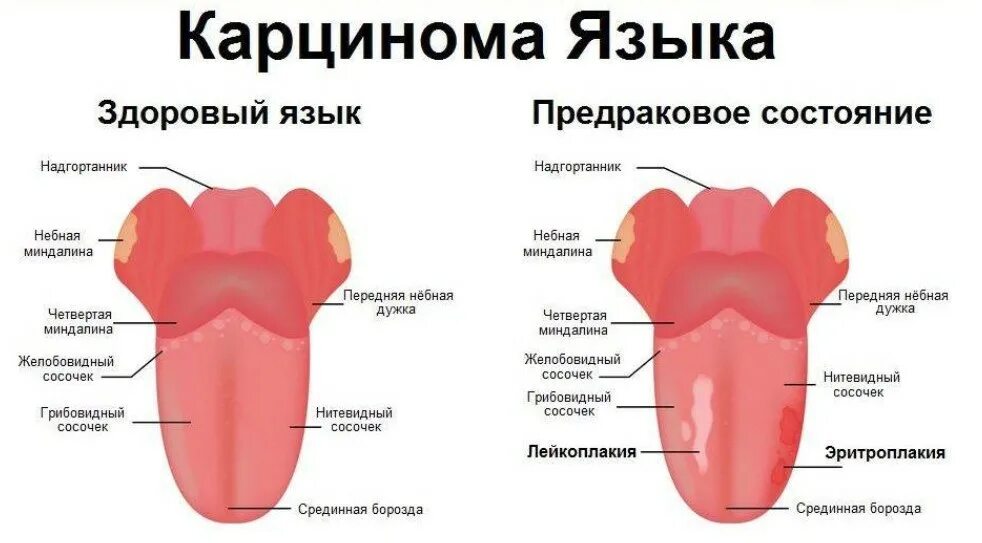 Признаки рака языка у женщин симптомы фото Рак ротовой полости: первые признаки и причины возникновения